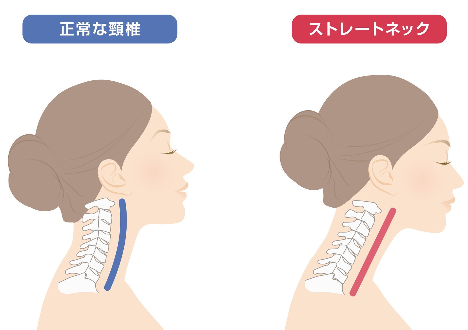 ストレートネック｜名取市のこばやし整形外科クリニック